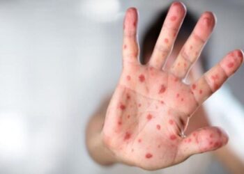 La propagation de la rougeole dans les régions du Nord suscite des inquiétudes et des alertes sur une catastrophe sanitaire imminente