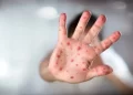 L’épidémie de rougeole au Maroc : une mobilisation urgente pour freiner la propagation