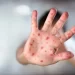 L’épidémie de rougeole au Maroc : une mobilisation urgente pour freiner la propagation